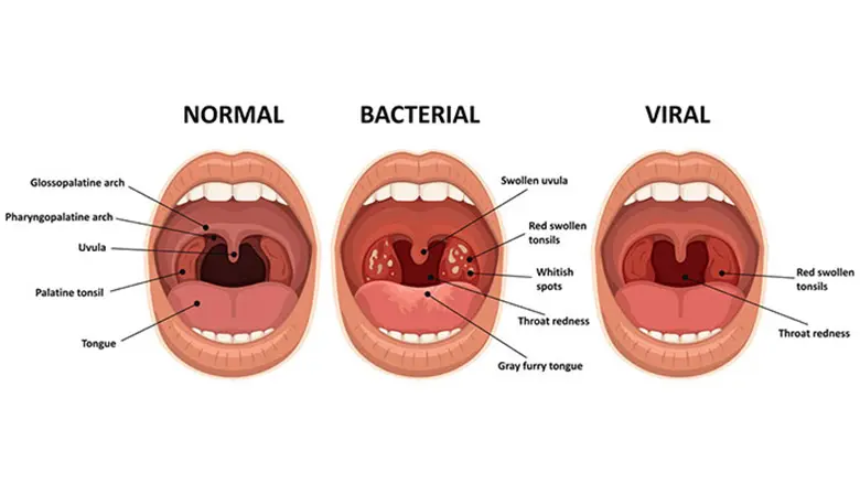 Your Guide to Tonsillitis Treatment and Tonsil Stone Removal Surgery