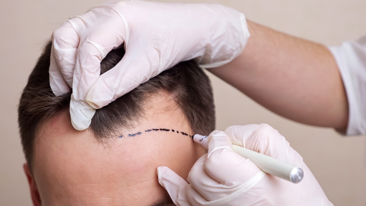 Top Reasons to Choose a Local Hair Transplant Clinic in Sydney